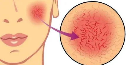 neurodermatitis érzékeny