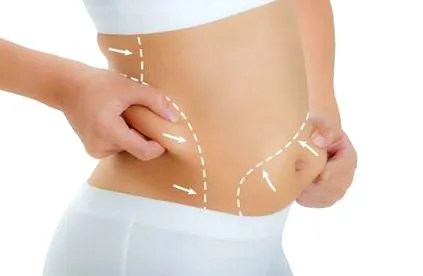 sculpsure