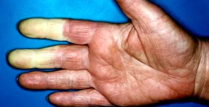 sindromul
