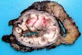 adenocarcinoma