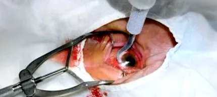 xanthelasma