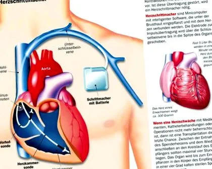 aritmii cardiace