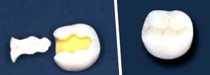 центар inlays
