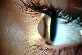 keratoconus