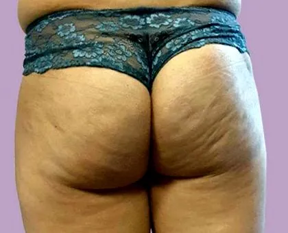 kezelés után