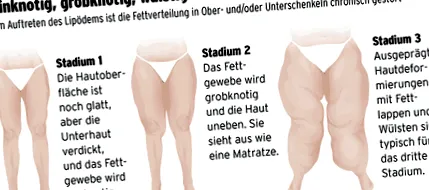 lipedema