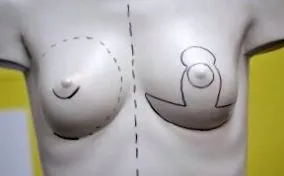 mellnagyobbítás