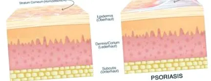 DermaSel Therapy