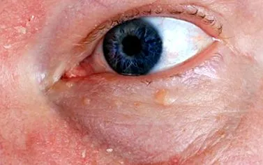 herpes