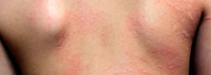 allergia tanácsok
