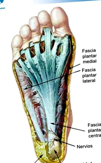 fasciitis