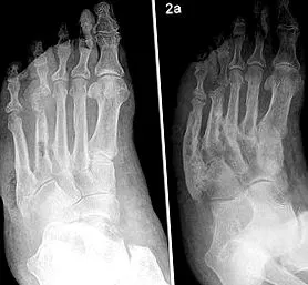 charcot