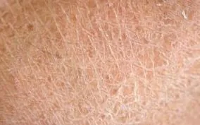 ichthyosis