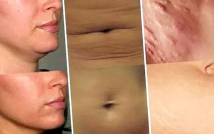 lipo lipo
