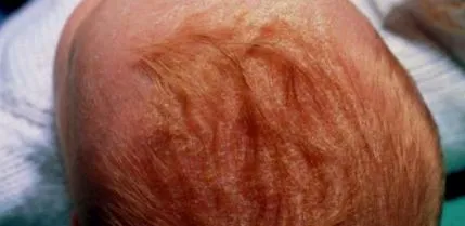 eczema