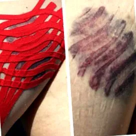 haematoma