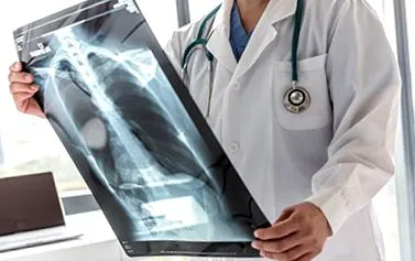 radiculopatie