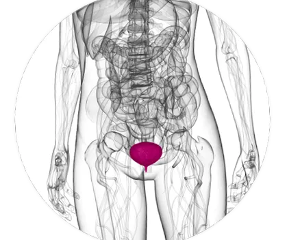 cystitis