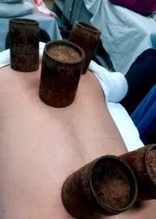köpölyözés
