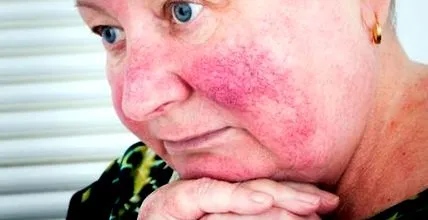 rosaceás