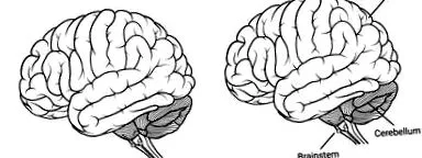 encephalopathia szubkortikális