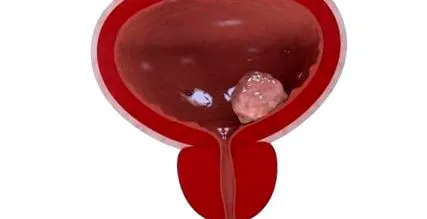 зрачен циститис