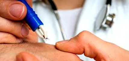 borrelioza