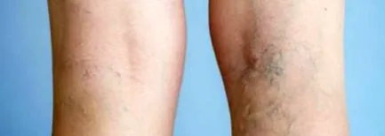 preveni