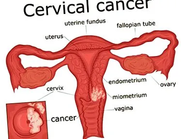 intraepitelială cervicală