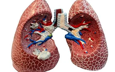 pneumonie