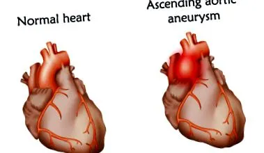 aortică cauze
