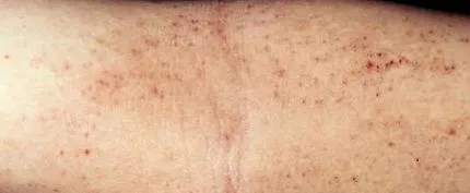 terhességi dermatózis