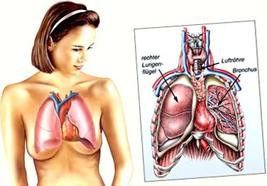 bronchiectasis