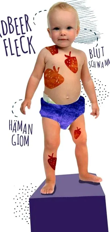 tratament hemangioame