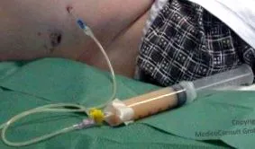 chylous ascites