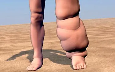 elephantiasis