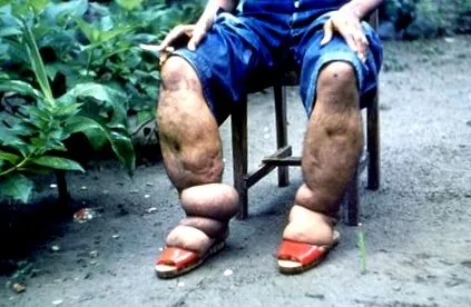 Elephantiasis tropica