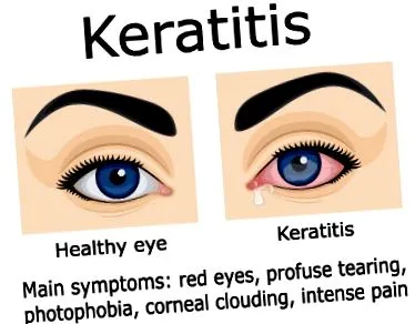 inflamația