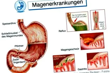 pylori