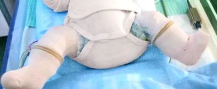 ftdysplasia
