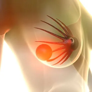 lumpectomie