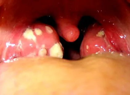 angina
