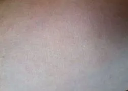 ekcémájától
