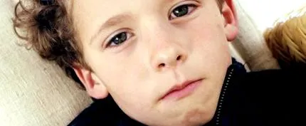 parotitis
