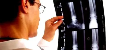 gyógyszertári osteomyelitis