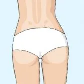 diastasis rectus