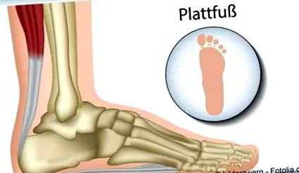 flatfoot