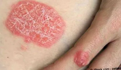 simptome psoriazis