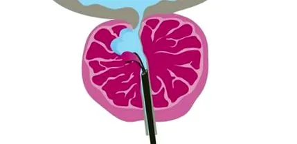 prostatei