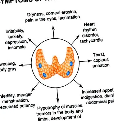 thyrotoxicosis